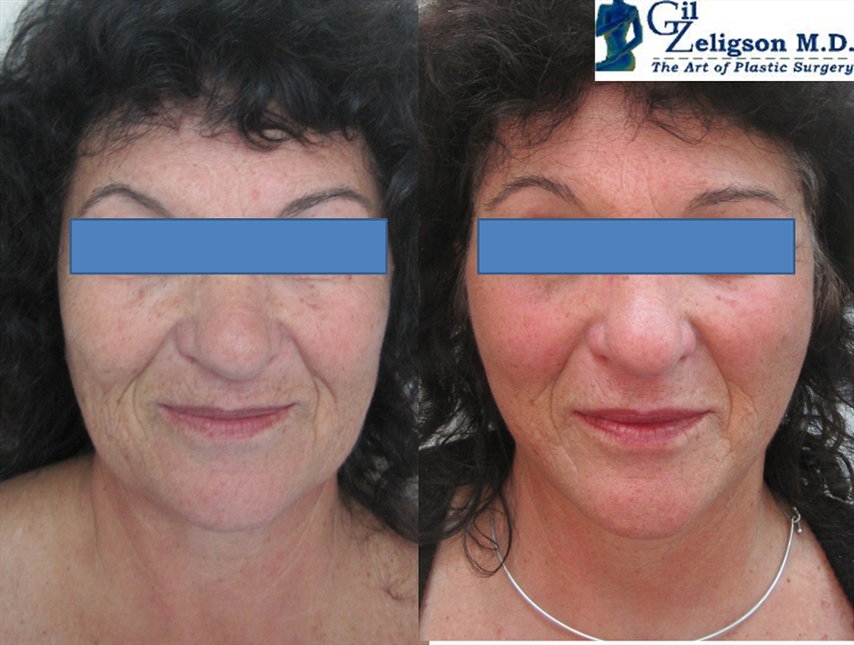 Dr. Gil Zeligson - Facelift