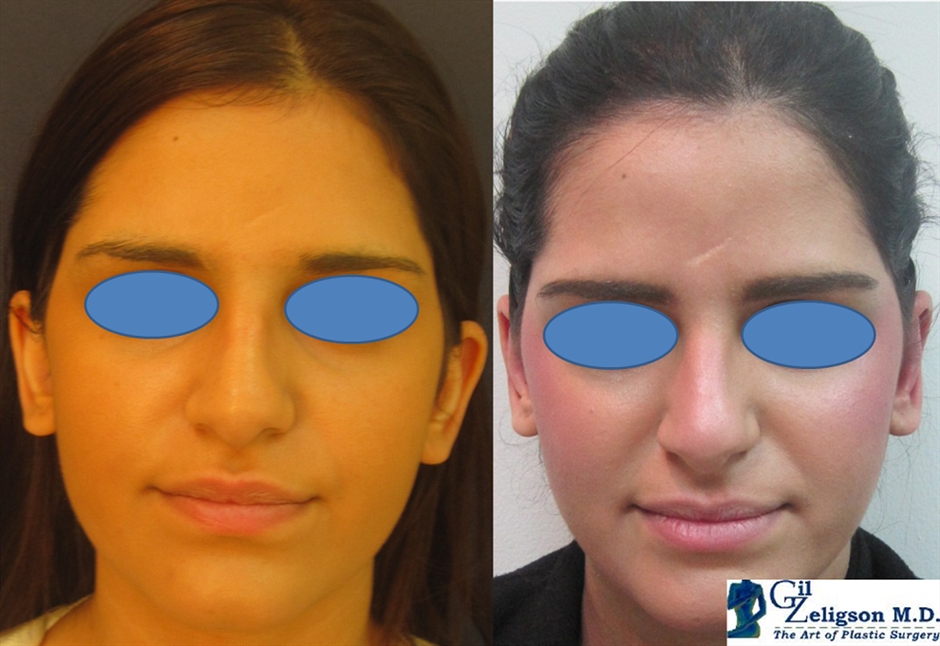 Dr. Gil Zeligson - Otoplasty