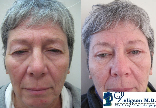 Dr. Gil Zeligson - Upper and Lower Eyelids