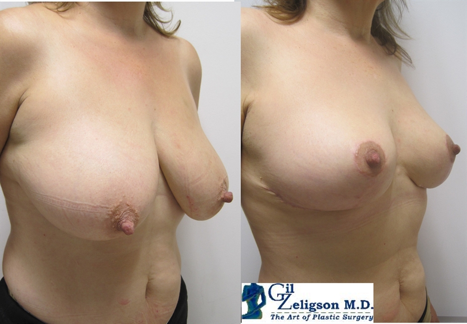 Dr. Gil Zeligson - Breast Reduction