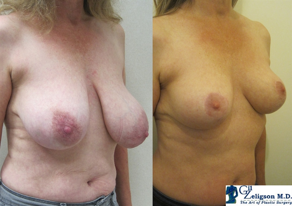 Dr. Gil Zeligson - Breast Reduction