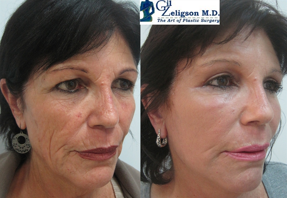 Dr. Gil Zeligson - Facelift