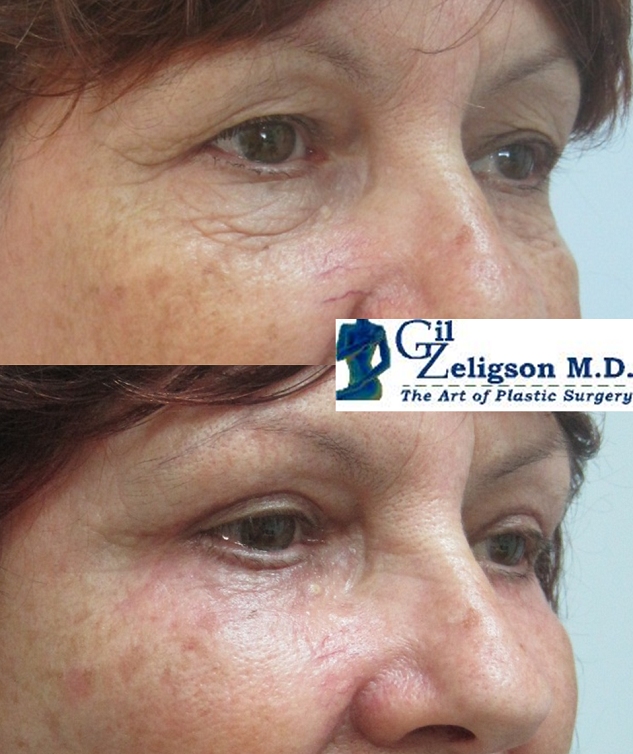 Dr. Gil Zeligson - Upper and Lower Eyelids