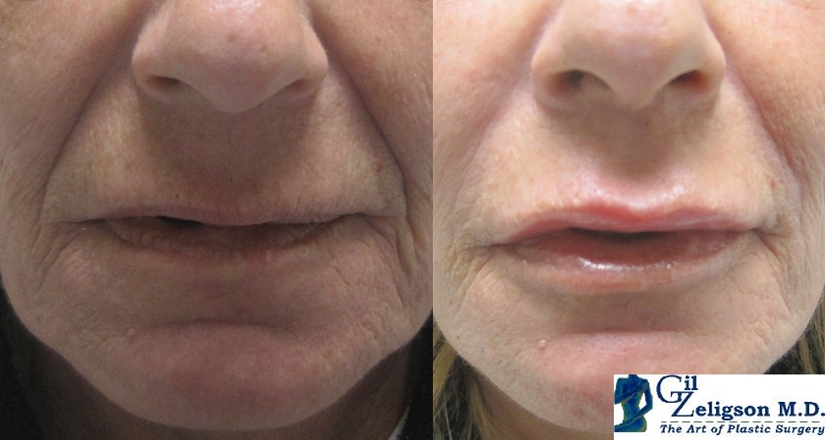 Dr. Gil Zeligson - Lips augmentaion & Wrinkles filling