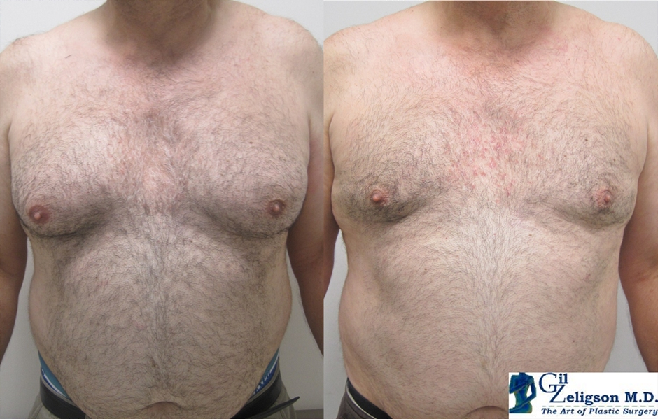 Dr. Gil Zeligson - Gynecomasty