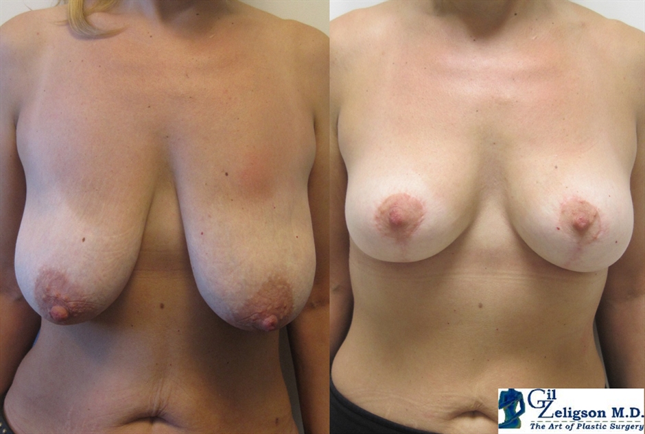 Dr. Gil Zeligson - Breast Reduction