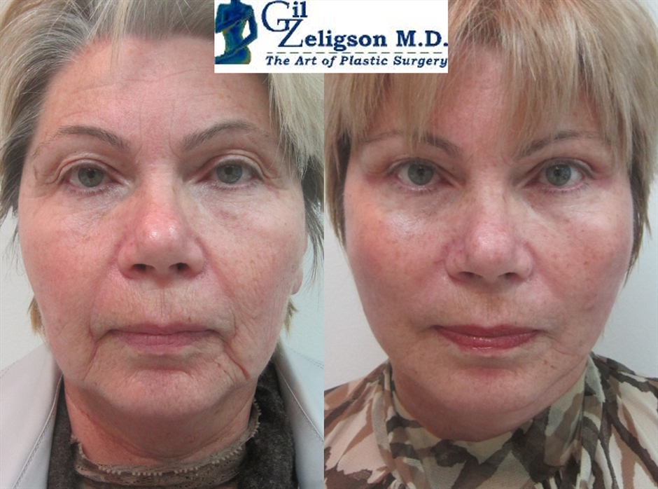 Facelift