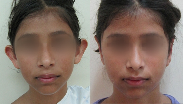 Dr. Gil Zeligson - Otoplasty