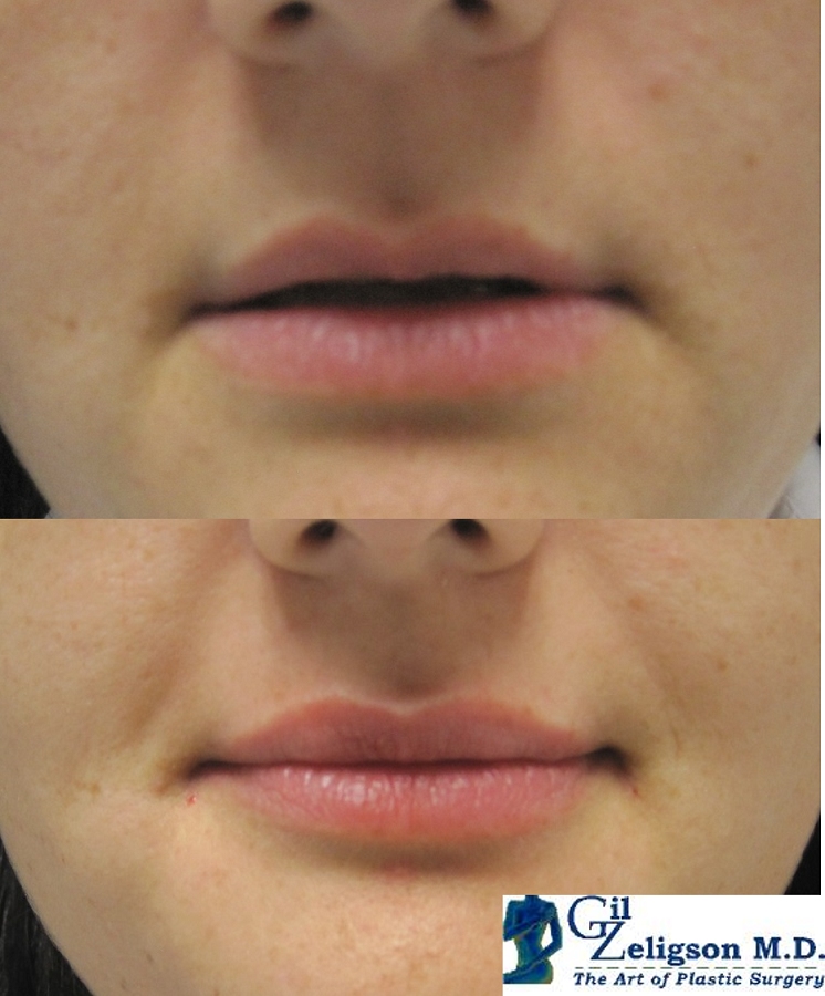 Dr. Gil Zeligson - Lips augmentaion & Wrinkles filling