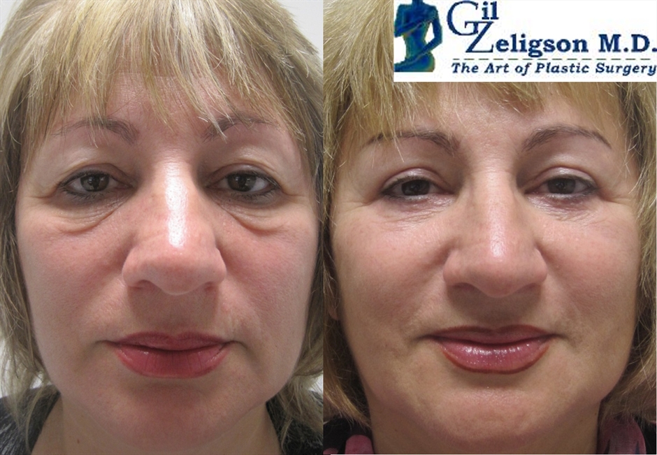 Dr. Gil Zeligson - Upper and Lower Eyelids