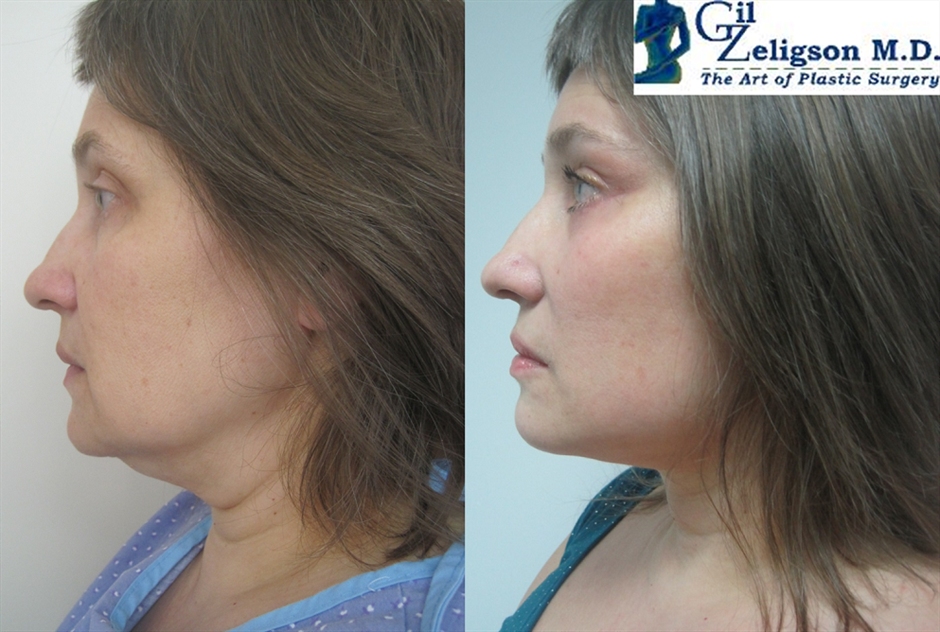 Dr. Gil Zeligson - Facelift