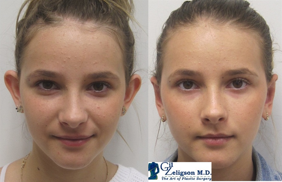 Dr. Gil Zeligson - Otoplasty