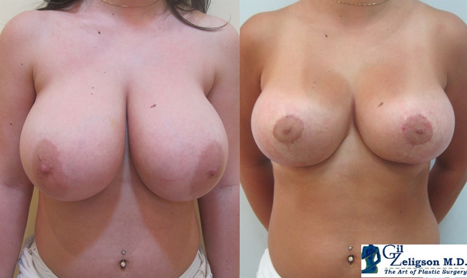 Dr. Gil Zeligson - Breast Reduction