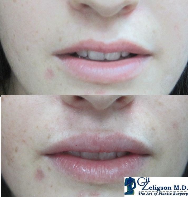 Dr. Gil Zeligson - Lips augmentaion & Wrinkles filling