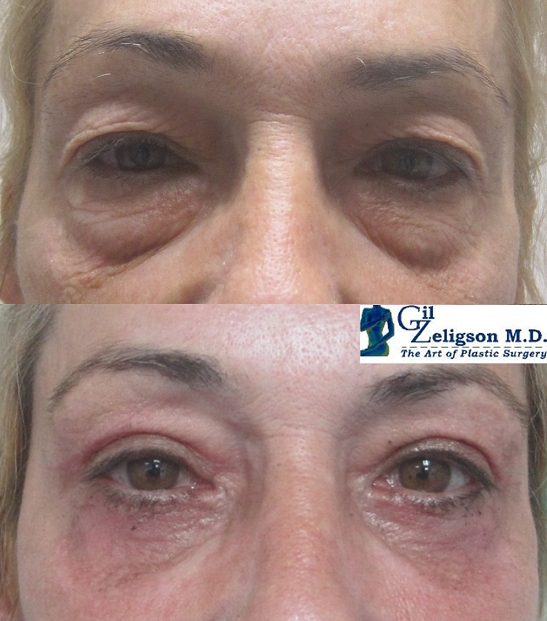 Dr. Gil Zeligson - Upper and Lower Eyelids