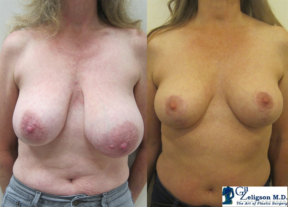 Dr. Gil Zeligson - Breast Reduction
