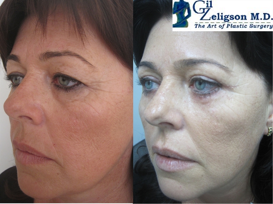 Dr. Gil Zeligson - Upper and Lower Eyelids