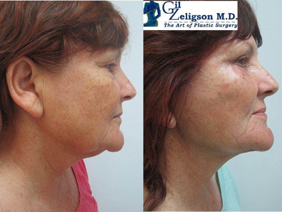 Dr. Gil Zeligson - Facelift