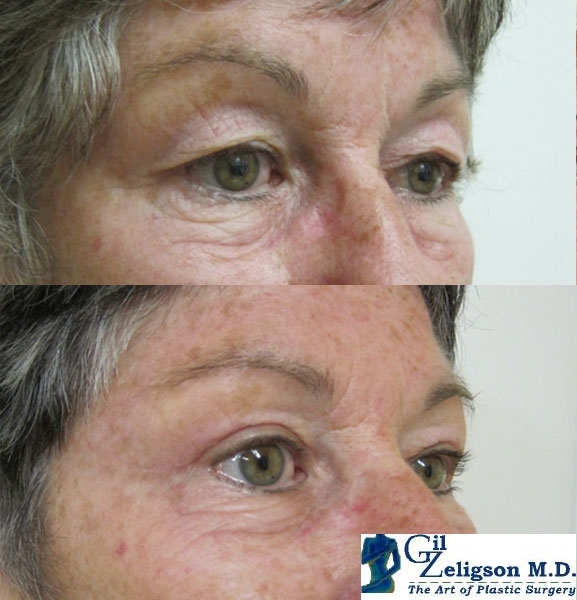 Dr. Gil Zeligson - Upper and Lower Eyelids