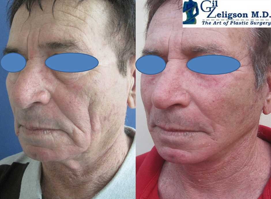 Dr. Gil Zeligson - Facelift