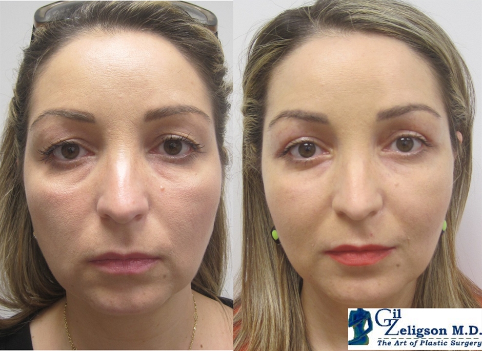 Dr. Gil Zeligson - Upper and Lower Eyelids