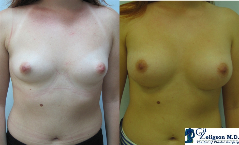 Dr. Gil Zeligson - Breast augmentation
