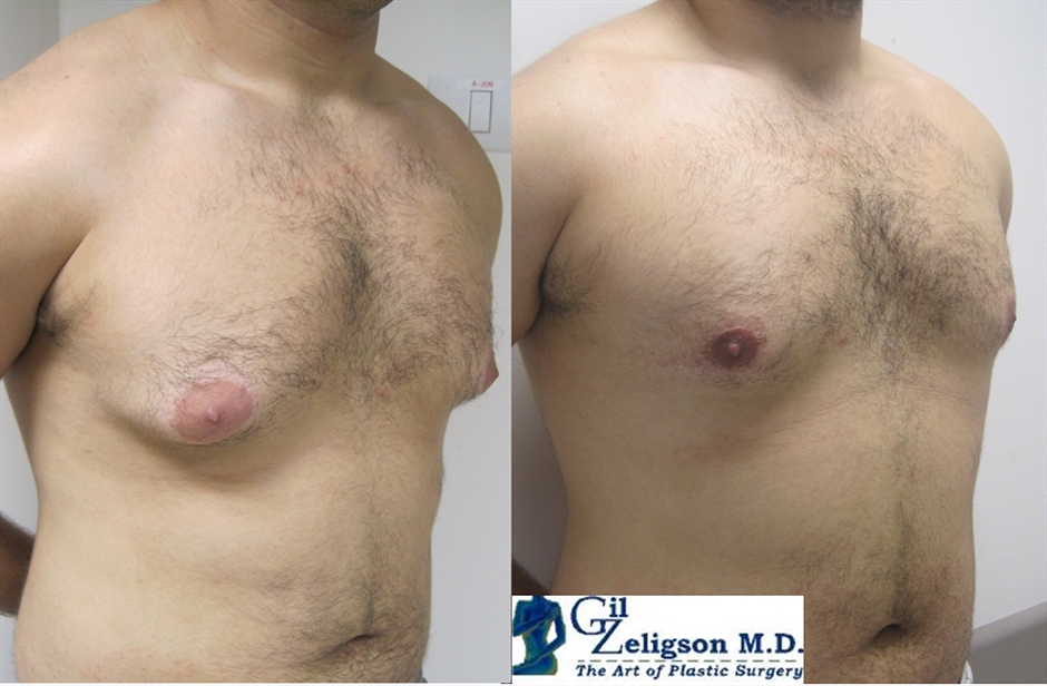Dr. Gil Zeligson - Gynecomasty