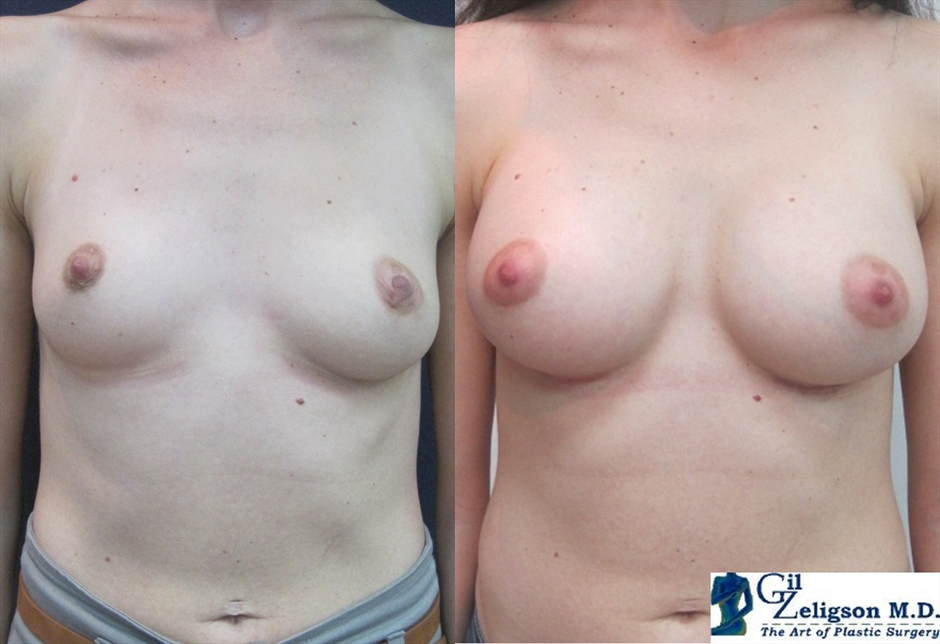 Dr. Gil Zeligson - Breast augmentation