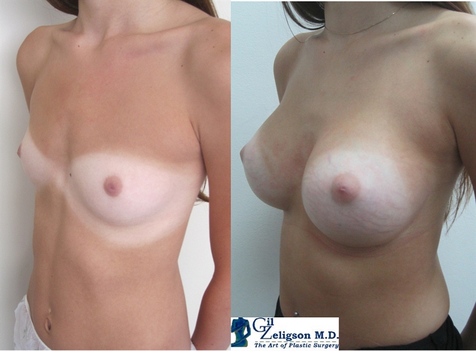 Dr. Gil Zeligson - Breast augmentation