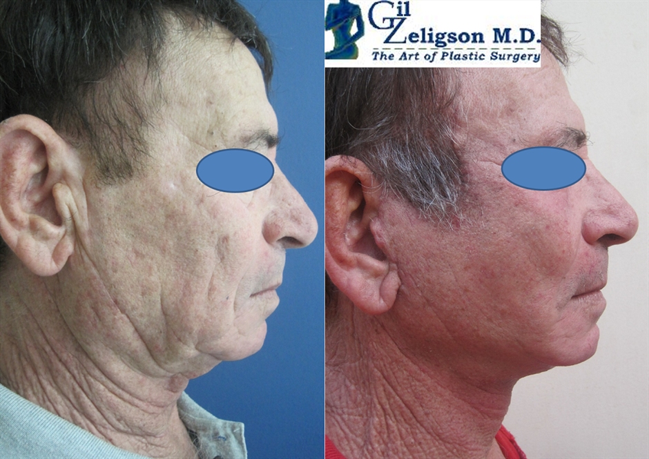Dr. Gil Zeligson - Facelift