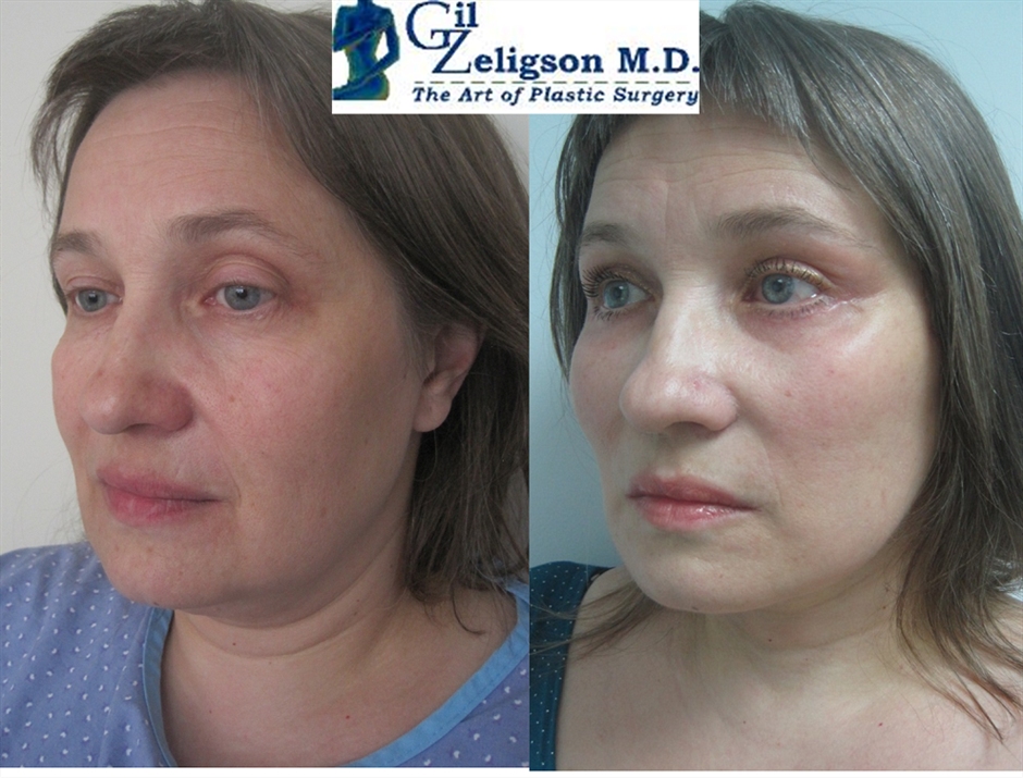 Dr. Gil Zeligson - Facelift
