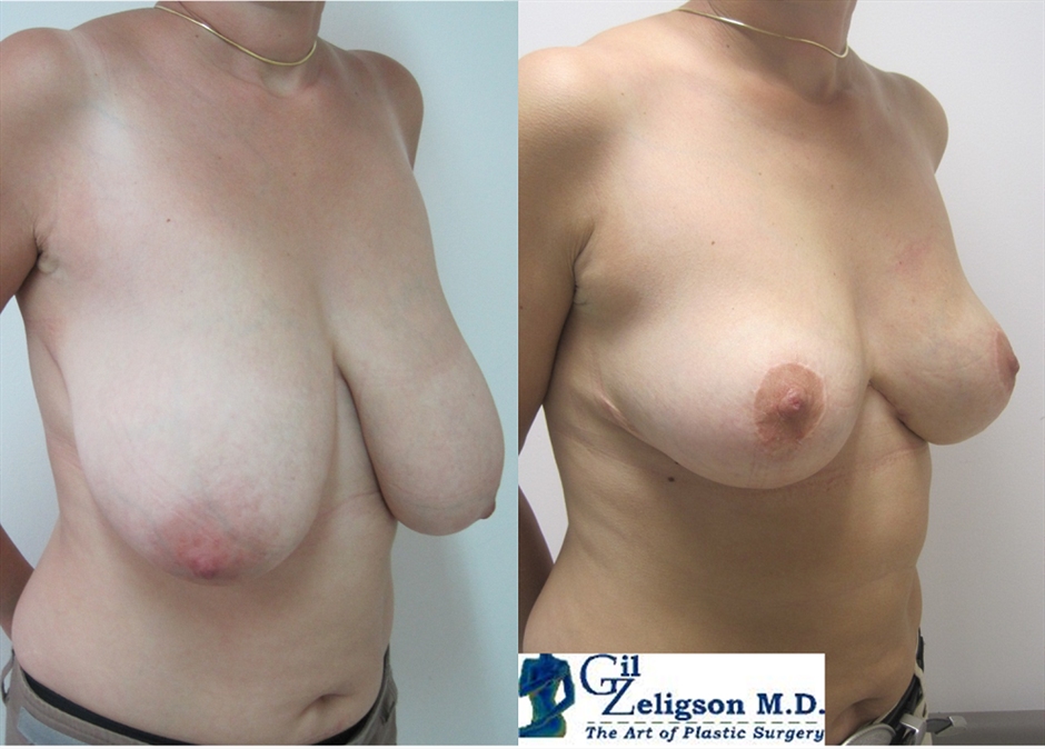 Dr. Gil Zeligson - Breast Reduction