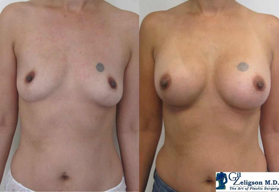 Dr. Gil Zeligson - Breast augmentation
