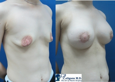 Dr. Gil Zeligson - Breast augmentation