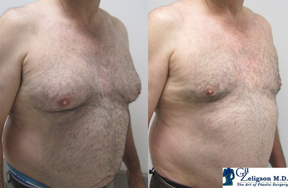 Dr. Gil Zeligson - Gynecomasty