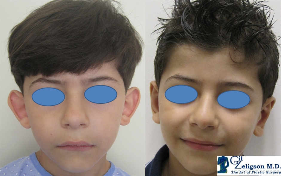 Otoplasty
