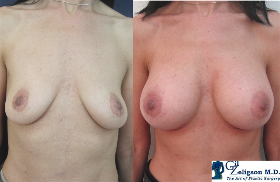 Dr. Gil Zeligson - Breast augmentation
