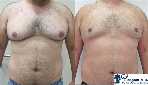 Gynecomastia