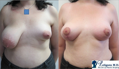 Dr. Gil Zeligson - Breast Asymmetry Correction