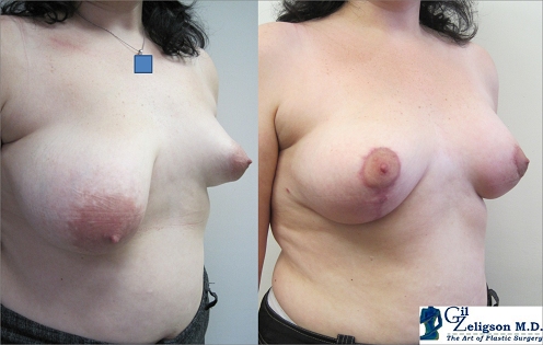 Dr. Gil Zeligson - Breast Asymmetry Correction