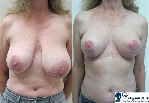 Dr. Gil Zeligson - Breast Asymmetry Correction