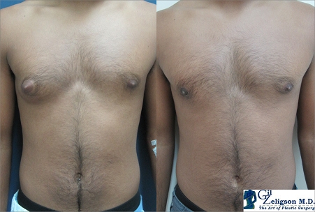 Dr. Gil Zeligson - Gynecomasty