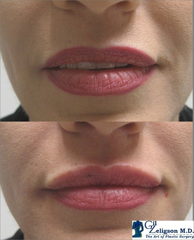 Dr. Gil Zeligson - Lips augmentaion & Wrinkles filling