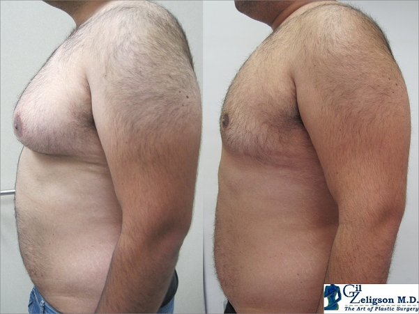 Dr. Gil Zeligson - Gynecomasty