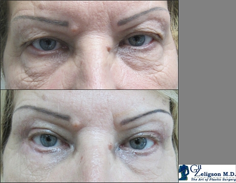 Dr. Gil Zeligson - Upper and Lower Eyelids