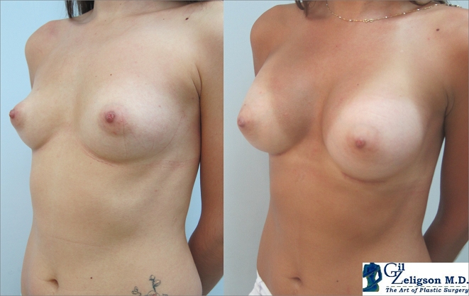 Dr. Gil Zeligson - Breast augmentation