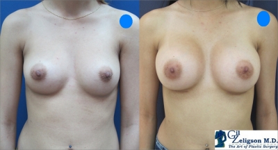 Dr. Gil Zeligson - Breast augmentation