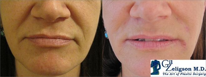 Dr. Gil Zeligson - Lips augmentaion & Wrinkles filling