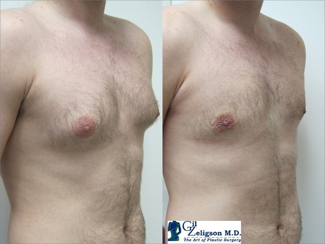 Dr. Gil Zeligson - Gynecomasty