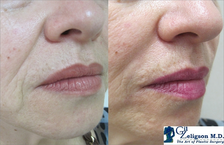 Dr. Gil Zeligson - Lips augmentaion & Wrinkles filling